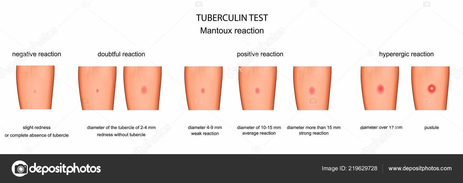 Реакция манту в 2 года. Норма диаскин диаскинтест. Прививка диаскинтест норма. Папула диаскинтест манту.