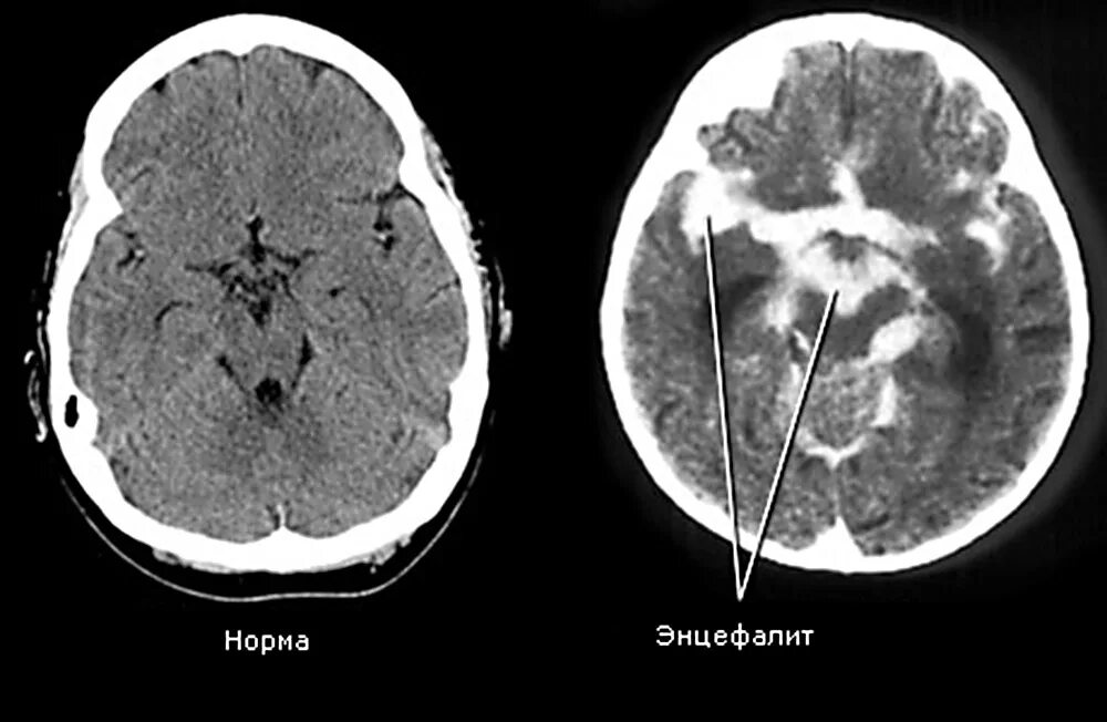 Мезэнцефальный энцефалит. Аутоиммунный энцефалит мрт. Ковидный энцефалит мозга. Энцефалит головного мозга у взрослых