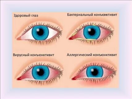 Симптомы конъюнктивита у детей 2