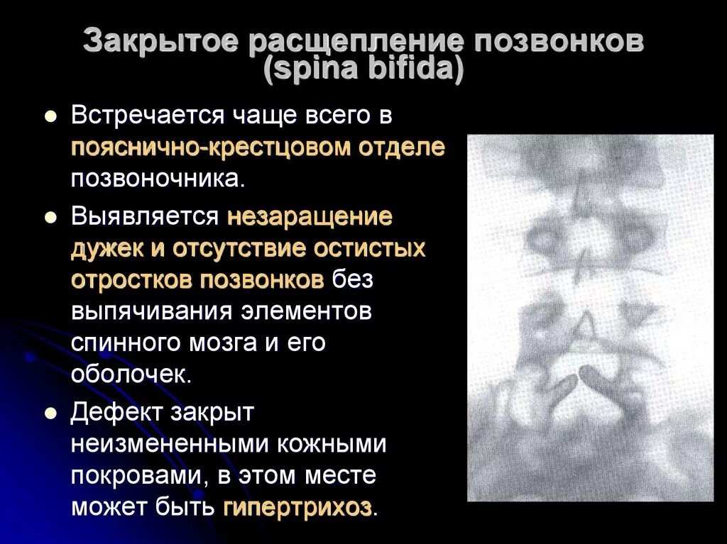 Аномалии развития нерва. Незаращение дужки s1 позвонка рентген. Расщепление дужки позвонка s1. Незаращение остистого отростка l5. Расщепление поперечного отростка l5.