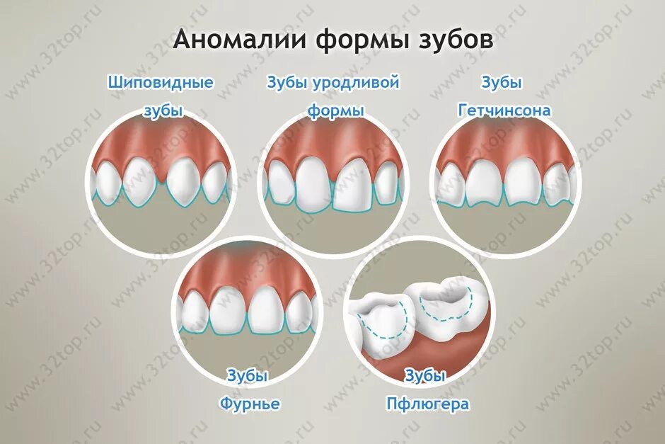 Почему зубы отличаются между собой у разных. Аномалии формы зубов зубы Гетчинсона. Аномалии формы зубов зубы Фурнье. Зубы Гетчинсона Фурнье Пфлюгера. Гипоплазия зубов зубы Гетчинсона.