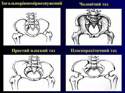 Плоский таз размеры