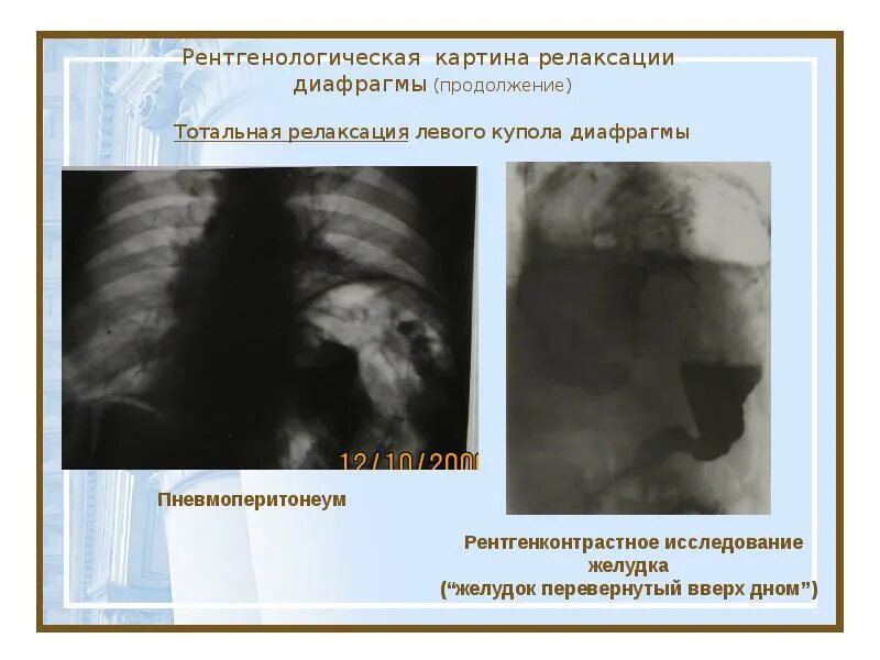 Релаксация купола диафрагмы справа. Стояние купола диафрагмы. Рклаксация куполов диаафрагмы. Опухоли диафрагмы рентген. Релаксация купола диафрагмы рентген.