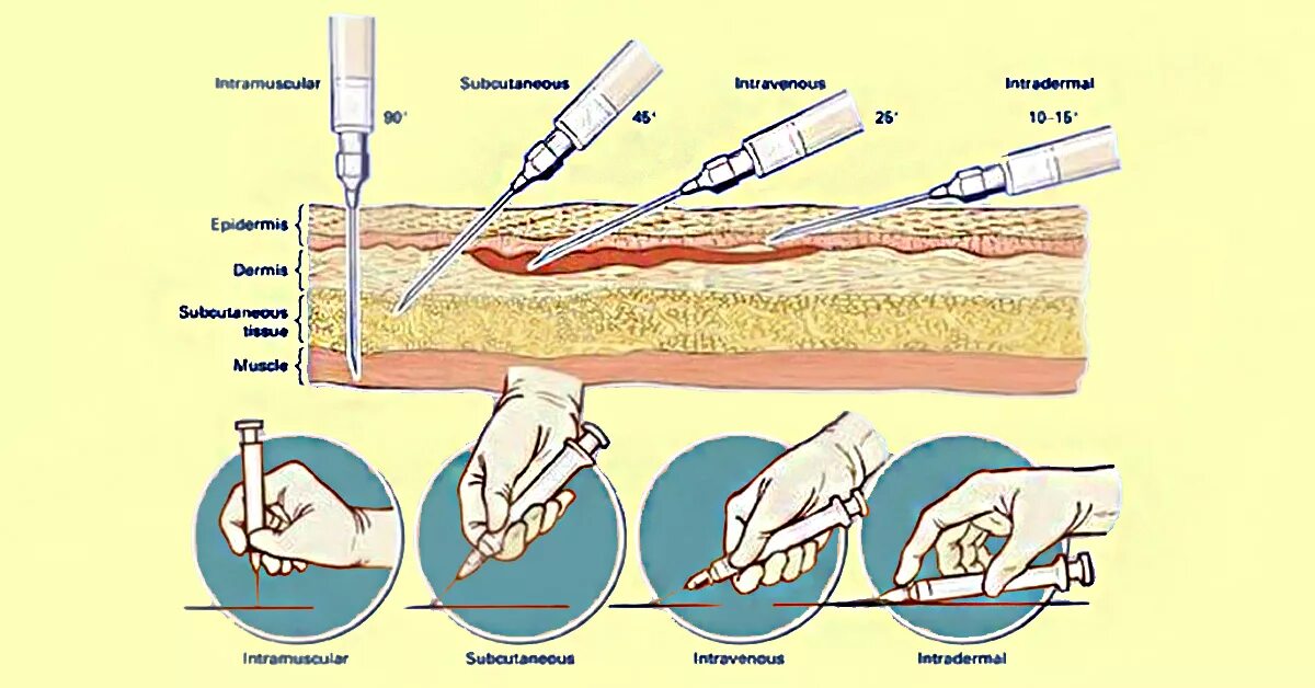 Внутримышечная внутривенная подкожная внутрикожная инъекция. Внутримышечная инъекция техника угол иглы. Внутривенная инъекция глубина введения иглы. Введения иглы при проведении внутримышечной инъекции.