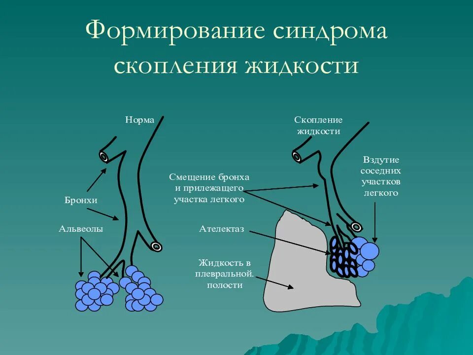 Воздух поступает в альвеолы. Альвеолы легких. Строение альвеол. Функции легочных пузырьков альвеол. Функция альвеол легких.