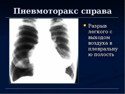 Порыв легкого