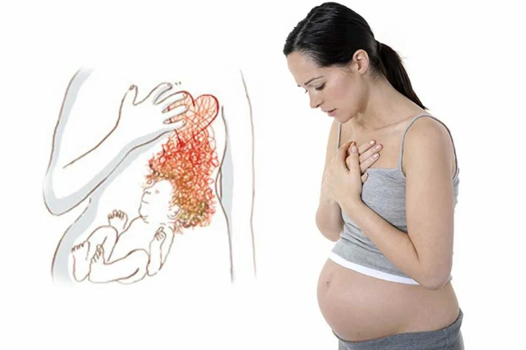 Беременна в 1. Изжога при беременности. Изжоге прибеременночти. При изжоге при беременности. Желудок изжога при беременности.