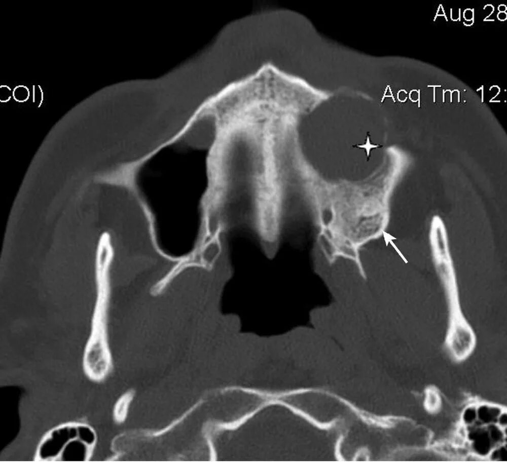 Кт гайморовых пазух носа. Кт остеомиелит гайморовой пазухи. Верхнечелюстная пазуха кт. Верхнечелюстной синусит кт. Утолщение слизистой оболочки решетчатых лабиринтов