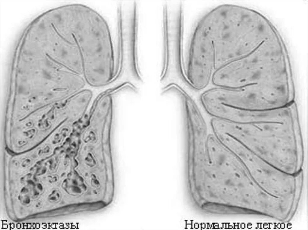 Бронхит бронхоэктатическая болезнь. Бронхоэктатическая эмфизема. Бронхоэктатическая болезнь и эмфизема. Бронхоэктатическая болезнь легкого. Бронхоэктатической болезни легких.