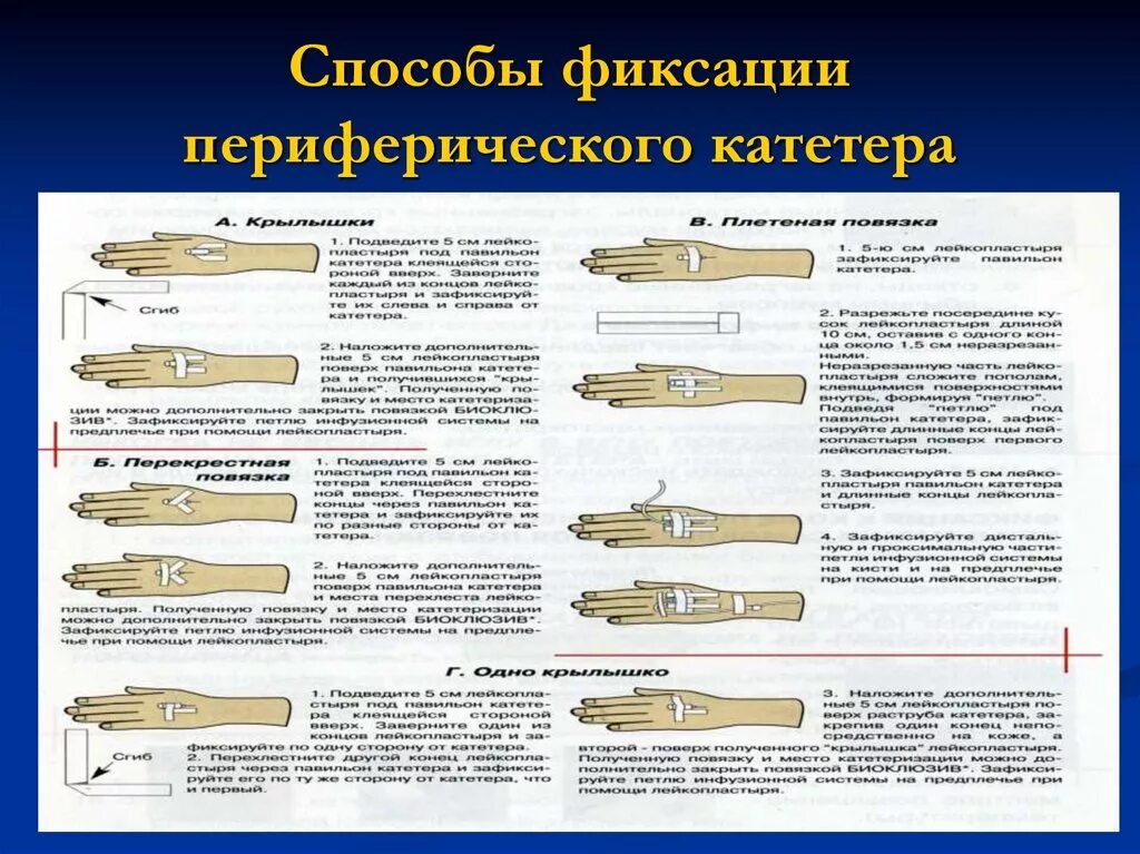 Катетеризация вены алгоритм. Алгоритм постановки внутривенного периферического катетера. Постановка периферического венозного катетера алгоритм. Таблица алгоритм постановки периферического катетера. Внутривенный катетер алгоритм.