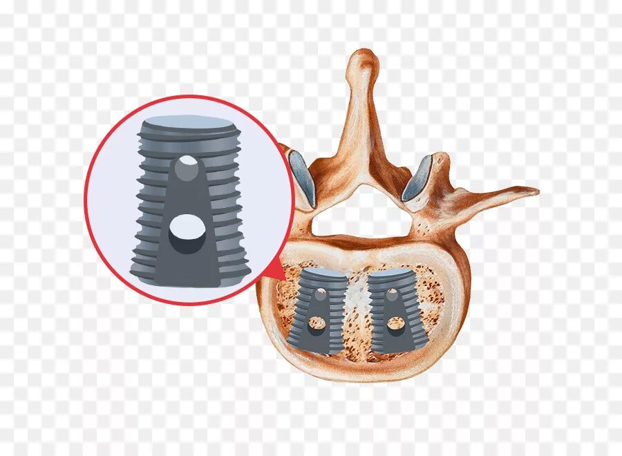 Имплант шейного отдела позвоночника. Спондилодез поясничного. Имплант Медтроник позвоночника. Спондилодез позвонков. Шейный спондилодез.
