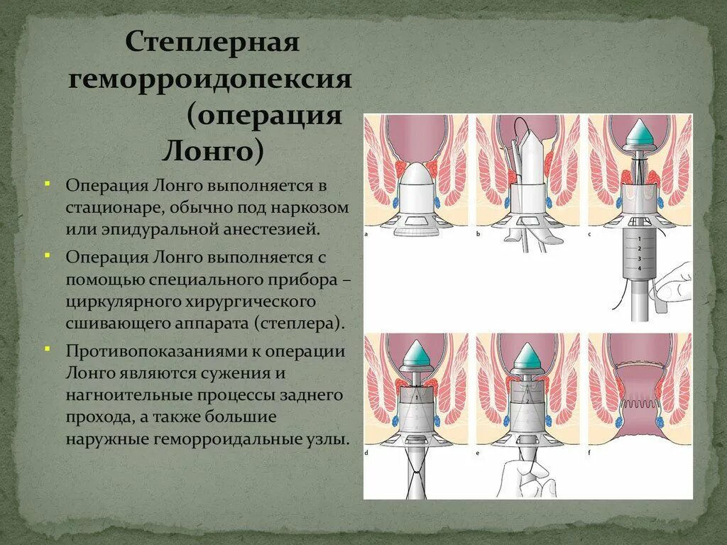 Задний транссфинктерный свищ прямой кишки. Удаление прямой кишки форум. Хирургические заболевания прямой кишки классификация. Протокол колоноскопии. Удаление прямой кишки форум.