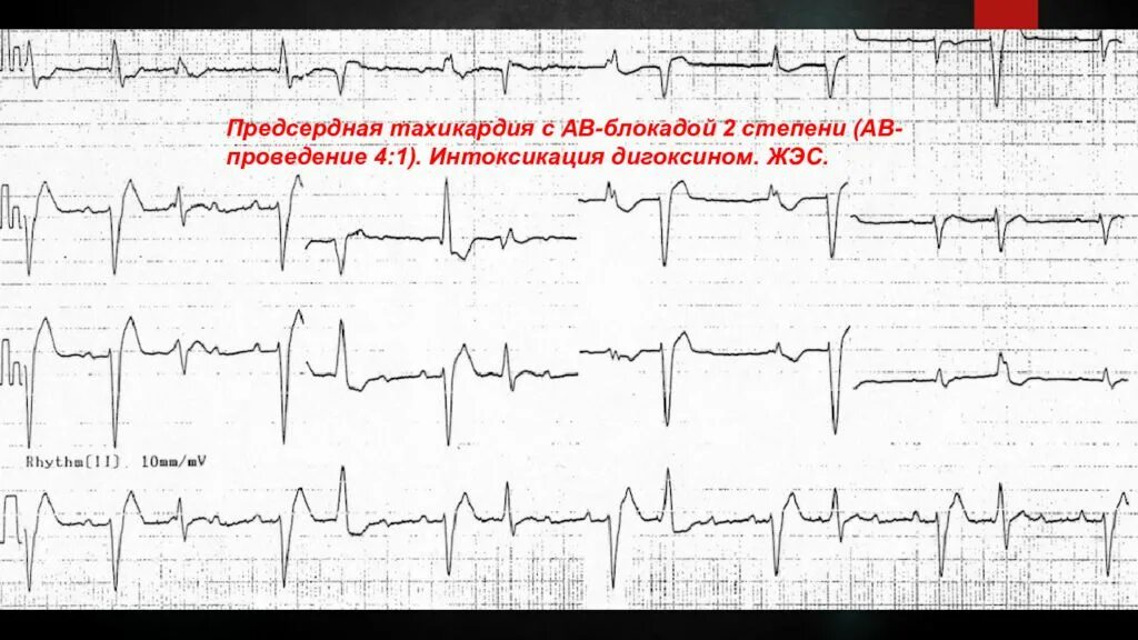 Предсердная блокада. Наджелудочковая тахикардия с АВ блокадой 2 степени. Синусовая тахикардия с АВ блокадой 2 степени. ЭКГ при предсердной тахикардии. Предсердная тахикардия с АВ блокадой на ЭКГ.