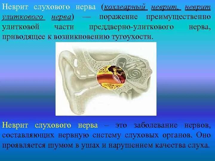 Поражение слухового нерва. Невритслуховогонерава. Поврежден слуховой нерв. Кохлеарный неврит. Кохлеарный неврит слухового.