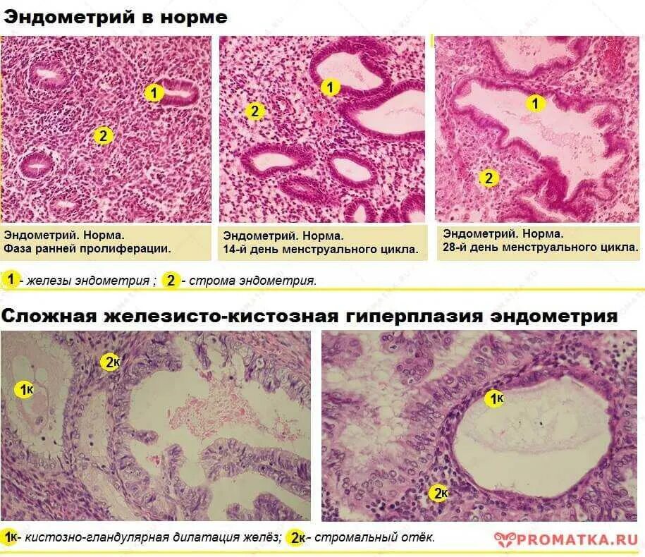 Гиперплазия эндометрия гистология. Гиперпластические процессы эндометрия гистология. Железистая гиперплазия эндометрия гистология. Железистая гиперплазия эндометрия гистология классификация. Изменение эндометрия матки