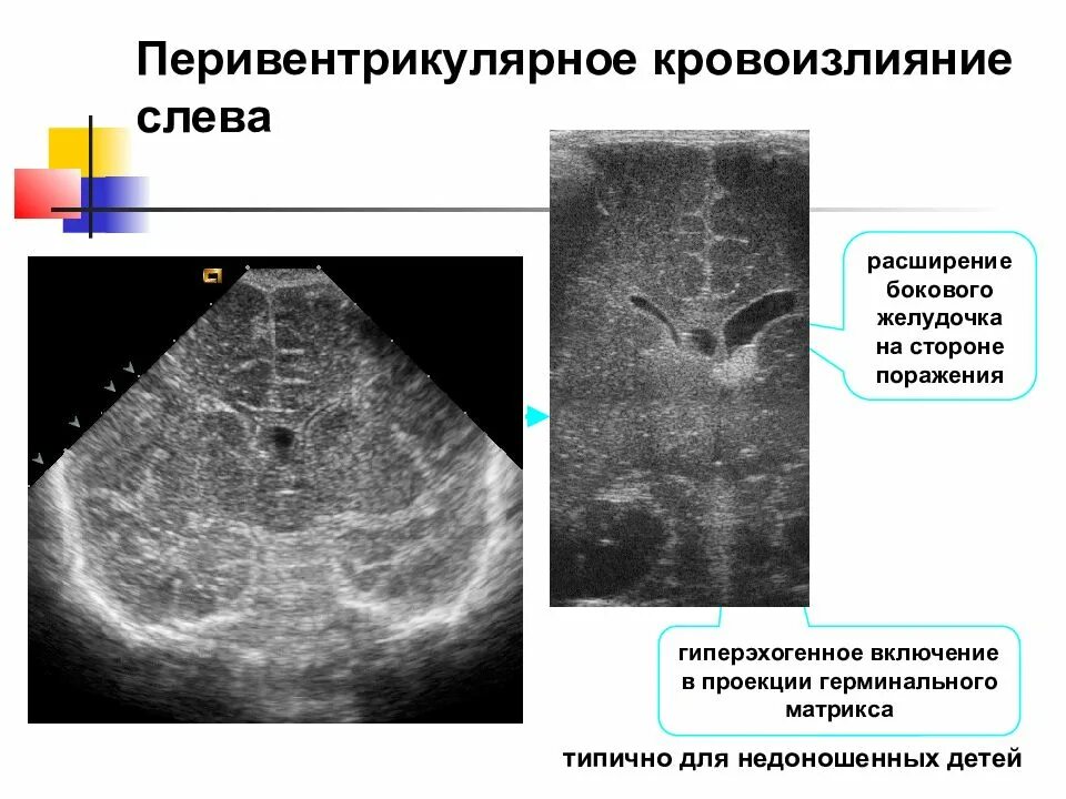 Кровоизлияние в желудочки. Перивентрикулярное кровоизлияние у новорожденных 1 степени. Субэпендимальное кровоизлияние УЗИ. Перивентрикулярное кровоизлияние на УЗИ.