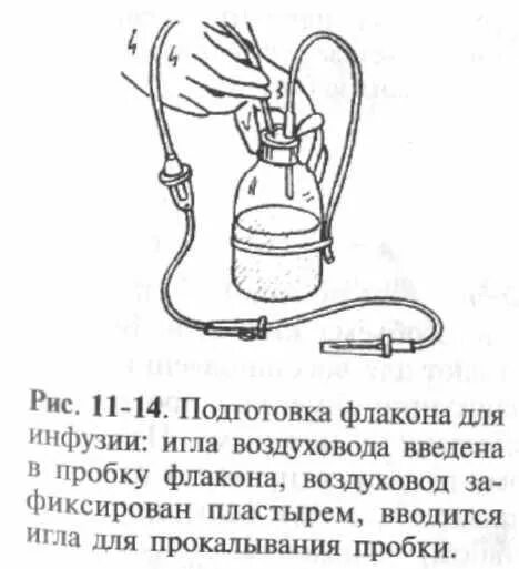 Воздуховод в системе для внутривенных капельных вливаний. Воздуховодная трубка в системе для внутривенных капельных вливаний. Заполнение системы для внутривенного вливания. Подготовка системы для внутривенного вливания.