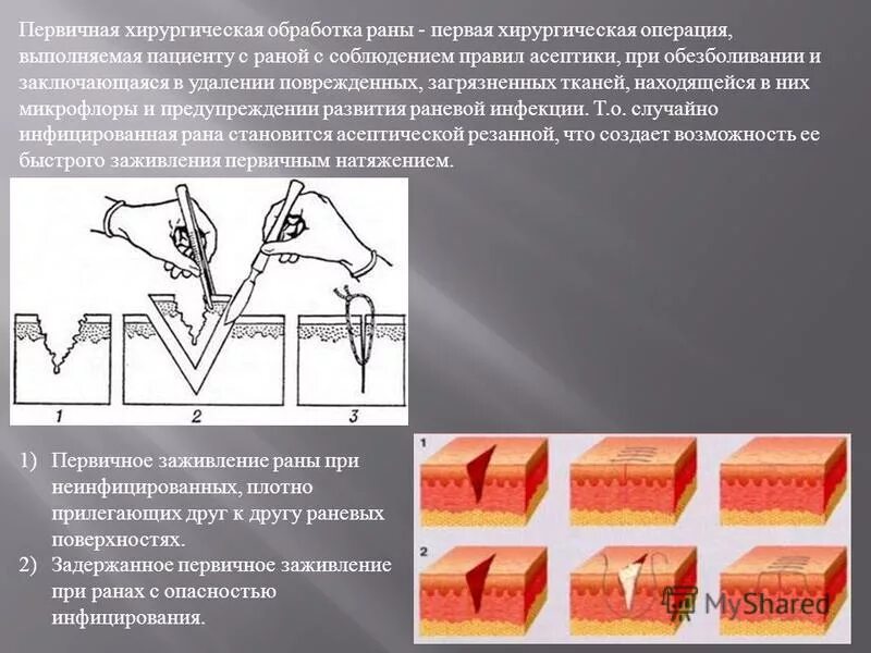 Первичная хирургическая обработка это. Первичная хирургическая обработка РАН хирургия. Первичная хирургическая обработка раны является методом.