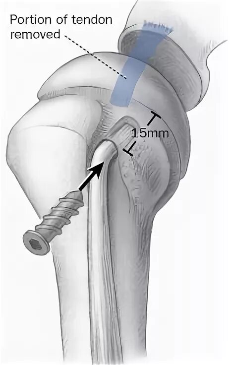 Тенодез сухожилия бицепса плечевого сустава. Тенодез длинной головки бицепса плечевого. Тенодез сухожилия длинной головки бицепса плеча. Тенотомия длинной головки бицепса плечевого сустава.