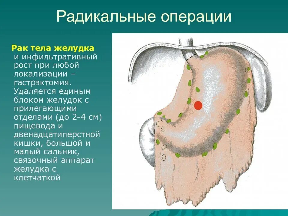 Язва операция сколько. Операции на желудке разрез. Новообразование в желудке. Радикальная операция при онкологии желудка.