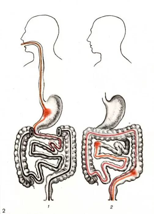 Кровотечения из пищеварительного тракта. Кровотечения из пищеварительного тракта. Кровотечения из пищеварительного тракта. Кровотечения из верхних отделов желудочно-кишечного тракта лечение. Кровотечение желудочно-кишечного тракта.
