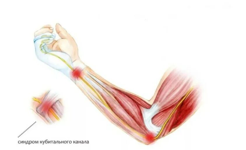 Локтевая невропатия лечение. Локтевой (кубитальный) туннельный синдром. Кубитальный синдром локтевого нерва. Туннельный синдром локтевого сустава. Синдром кубитального канала локтевого сустава.