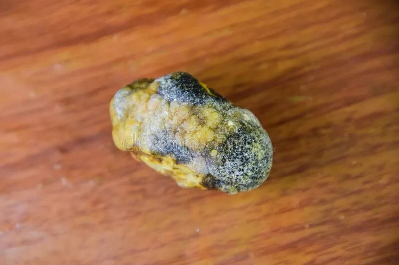 Желчный пузырь камни до 7 мм. Камни в жёлчном пузыре смакропрепарат.