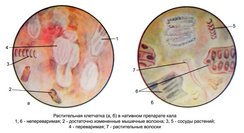 Микроскопия кала растительная клетчатка переваримая. Копрология кала микроскопия. Непереваримая растительная клетчатка в Кале. Растительная клетчатка в Кале микроскопия. Перевариваемая растительная клетчатка в кале у ребенка