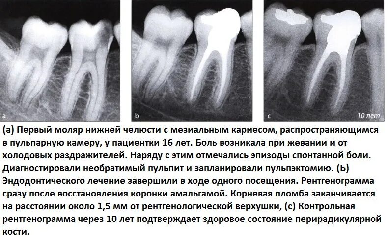Восстановление после эндодонтического лечения. Пространство периодонтальной связки. Расширение периодонтальной связки зуба. Оценка результатов эндодонтического лечения. Заживление периодонтальной связки зуба.