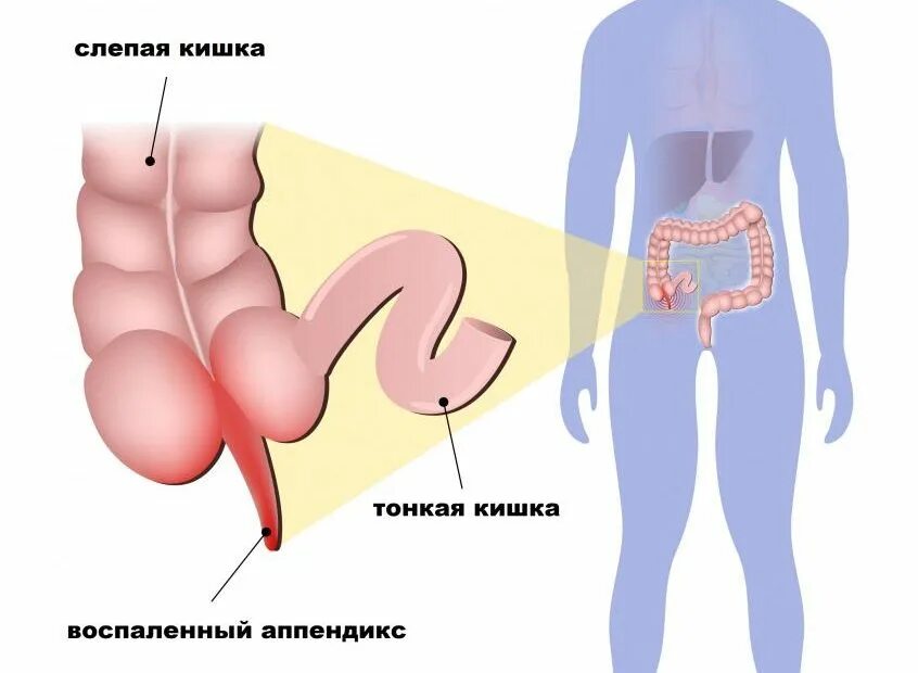 Где у человека расположен аппендицит. Воспаленный аппендикс.