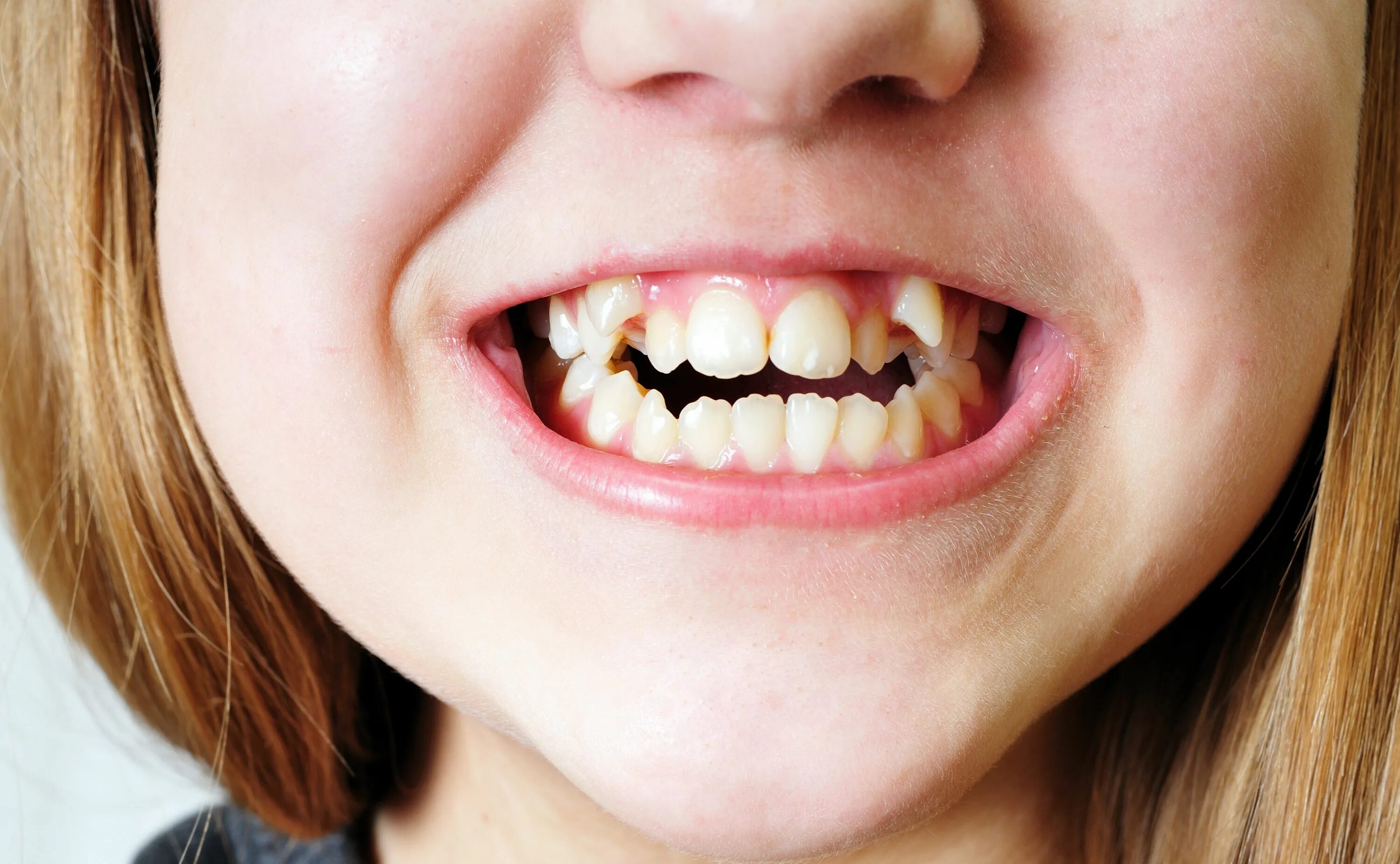 Почему больные зубы. Гипердонтия (сверхкомплектные зубы. Гипердонтия аномалия числа зубов.
