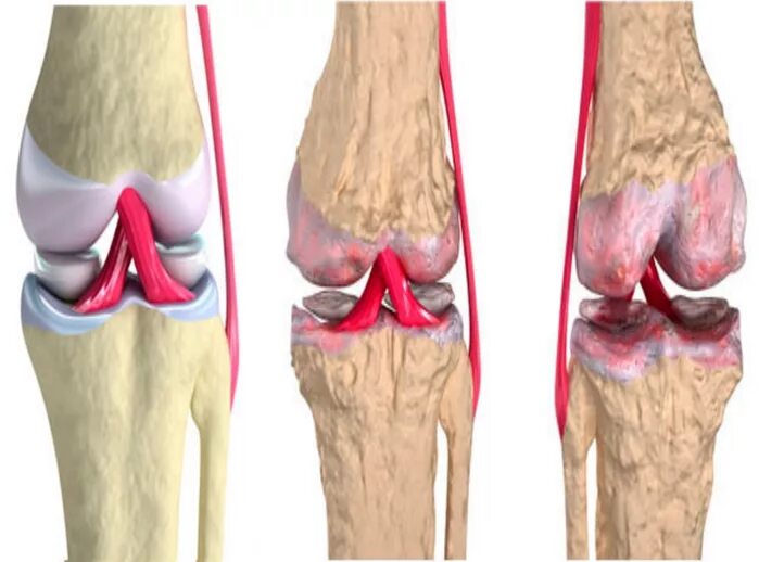 Остеоартрит локтевого сустава. Деформирующий артроз (остеоартроз). Артрозо-артрит коленного сустава. Что разрушает суставы