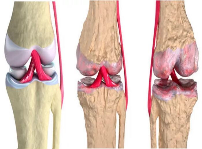 Что разрушает суставы. Остеоартрит локтевого сустава. Деформирующий артроз (остеоартроз). Артрозо-артрит коленного сустава.