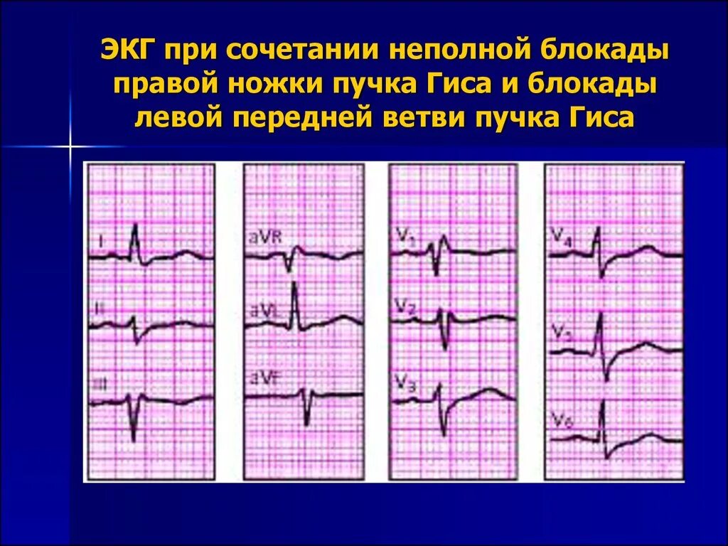 Форум левая ножка пучка гиса. Блокада пнпг и передней ветви лнпг на экг. полная блокада ножек пучка гиса на экг. полная правая блокада пучка гиса на экг. экг при блокаде правой и левой ножки пучка гиса.