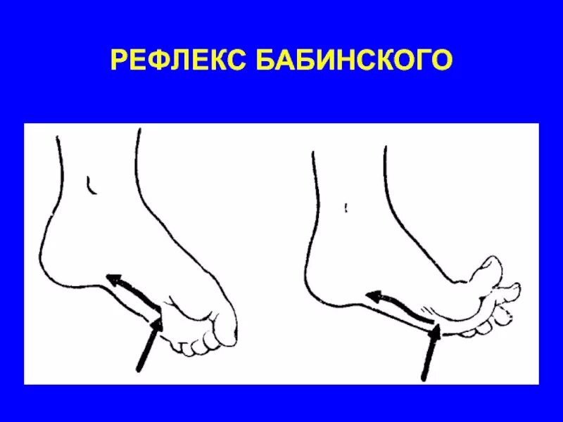 Положительные рефлексы. Рефлекс Бабинского сгибательный. Подошвенный рефлекс Бабинского. Патологический стопный рефлекс Бабинского. Патологические рефлексы симптом Бабинского.