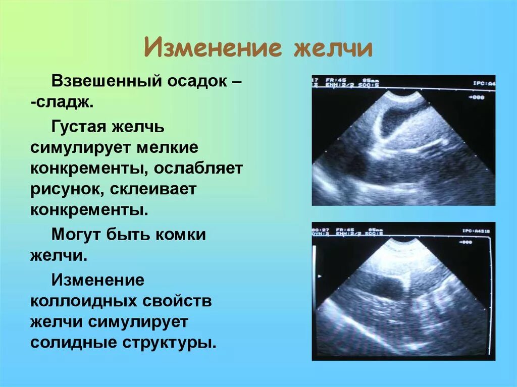 Эхопризнаки желчного пузыря. Застой желчного пузыря на УЗИ. Густая желчь в желчном пузыре. Застой желчи в желчном пузыре УЗИ. Густая желчь в желчном пузыре УЗИ.