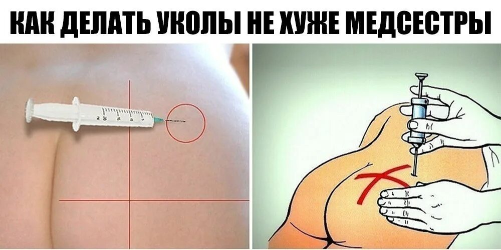 Поставь большой укол. Как правильно делать укол. укол внутримышечно. ка уделают укол в ягодицу. места для введения внутримышечных инъекций в яг.