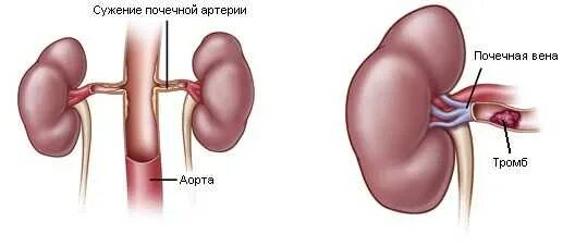 Тромбоз почечной артерии кт. Добавачно почечная Вена. Тромбоз почечной артерии