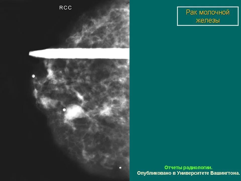 Маммография старый. Протокол описания маммографии. Как выглядит образование на маммографии. Измененный лимфоузел на маммографии. Маммография столбиков материала после биопсии.