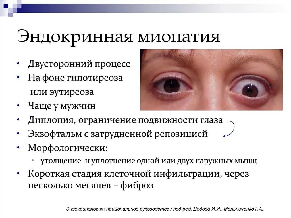 Двоение в одном глазу. Эндокринная офтальмопатия дифференциальный диагноз. Симптомы офтальмопатии. Эндокринная офтальмопатия 2 степени. Глаза при тиреотоксикозе.