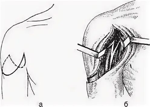 Лоскутная ампутация. Ампутация плеча в верхней трети по Фарабефу. Экзартикуляция плечевого сустава. Двухлоскутная ампутация плеча. Ампутация области плечевого сустава экзартикуляция плеча.