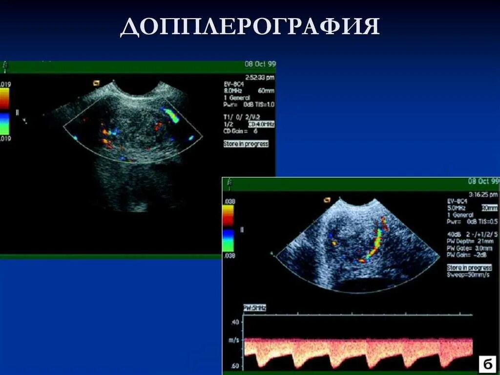 Что такое уздг. Допплерография. Допплерография применяется для. УЗДГ методика. Допплерометрия сосудов почек.