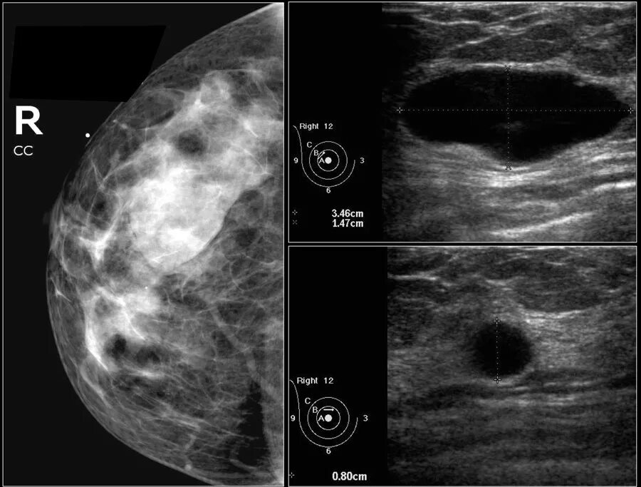 Фиброаденоматоз bi. Bi rads 4 молочной железы маммография. Birads 2 молочной железы что это такое. Bi rads молочной железы классификация УЗИ. Маммография bi-rads 2.