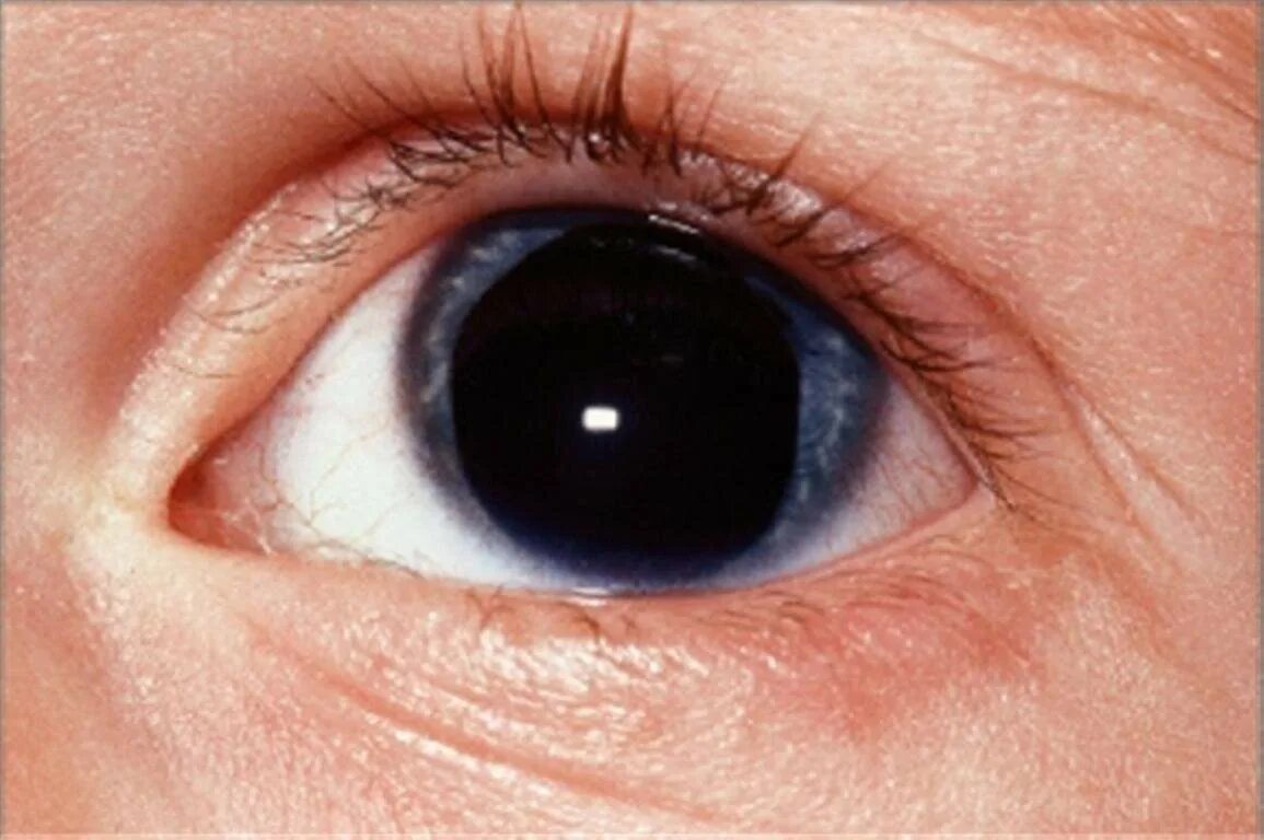 Аниридия отсутствие Радужки. Гетерохромия Фукса катаракта. Детям расширение зрачков