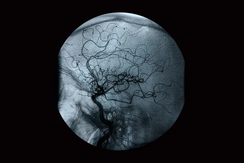 Сосуды головного мозга норма. Рентгеновская ангиография. Дигитальная субтракционная ангиография. Рентгеноконтрастная ангиография.