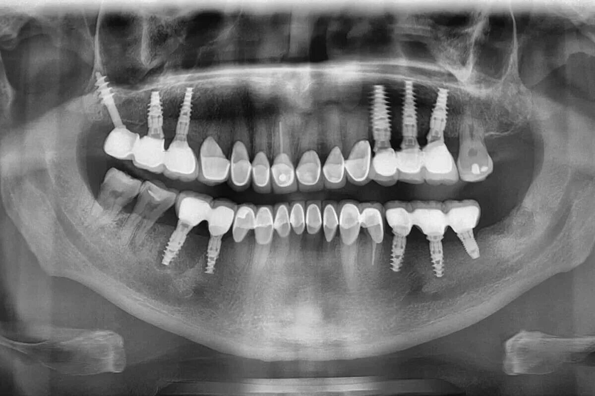 Ортопантомограмма ортогнатический прикус. ОПТГ зубных рядов Пикассо.