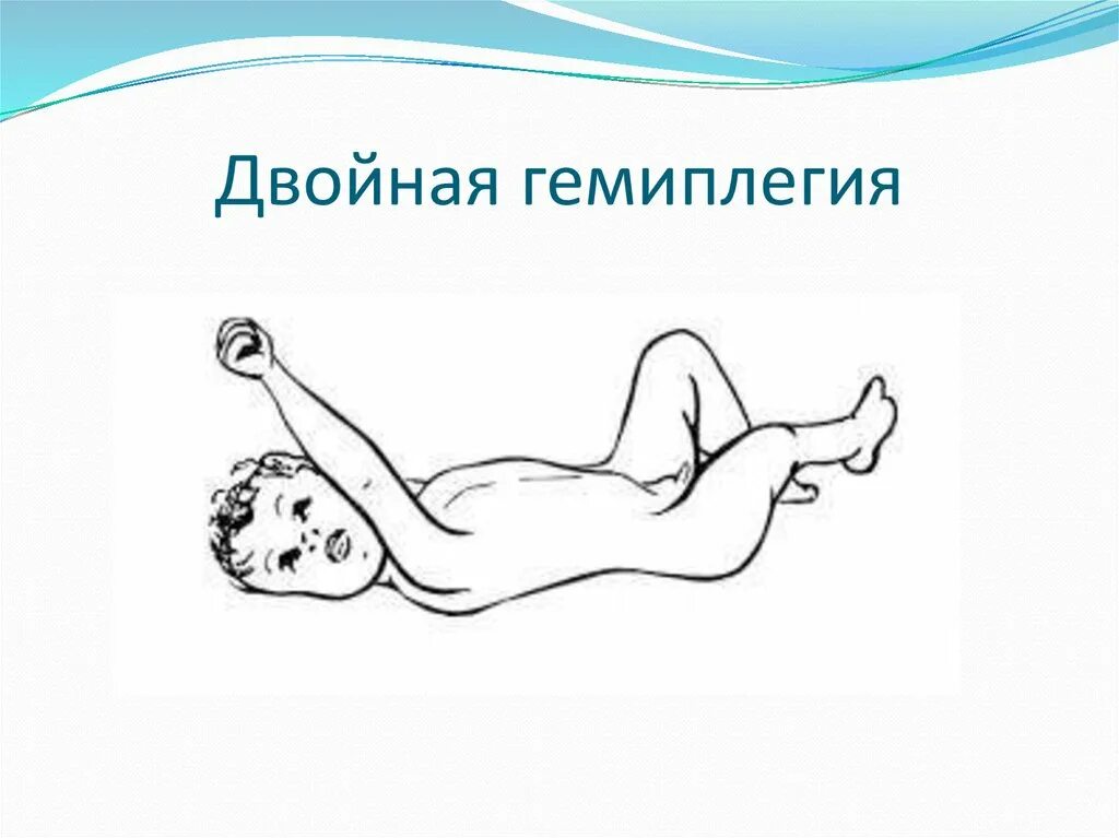 Двойная гемиплегия это форма дцп. Двойная (двусторонняя) гемиплегия. Дцп двойная спастическая гемиплегия. Спастический тетрапарез (двойная гемиплегия). Спастическая гемиплегия форма дцп.