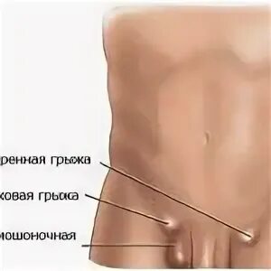 Паховая грыжа у мужчин симптомы лечение фото Картинки УЩЕМЛЕННАЯ ПРАВОСТОРОННЯЯ ПАХОВАЯ ГРЫЖА