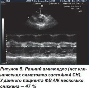 Амилоидоз узи