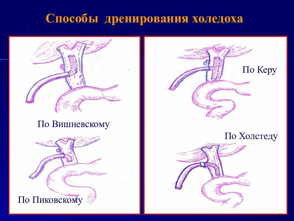 Желчевыводящий дренаж